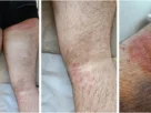 Supermicose: Fungo Resistente Inédito no Brasil Alerta de Saúde