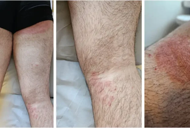Supermicose: Fungo Resistente Inédito no Brasil Alerta de Saúde
