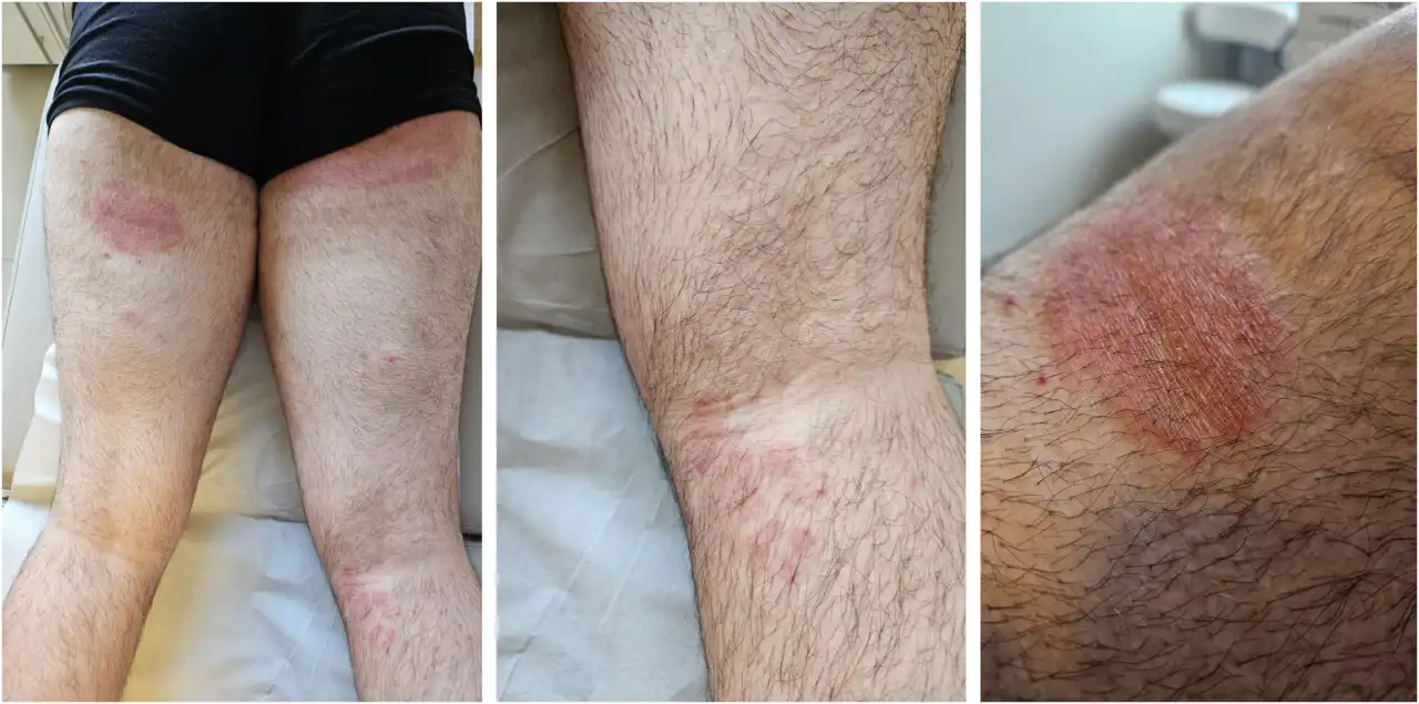 Supermicose: Fungo Resistente Inédito no Brasil Alerta de Saúde